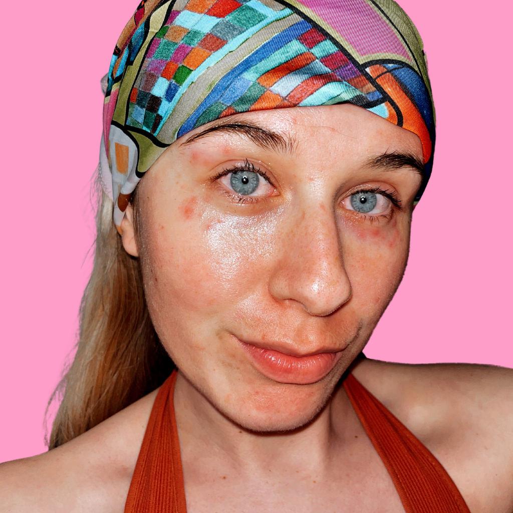 I’m the girl who used Topical Steroids for&nbsp;years