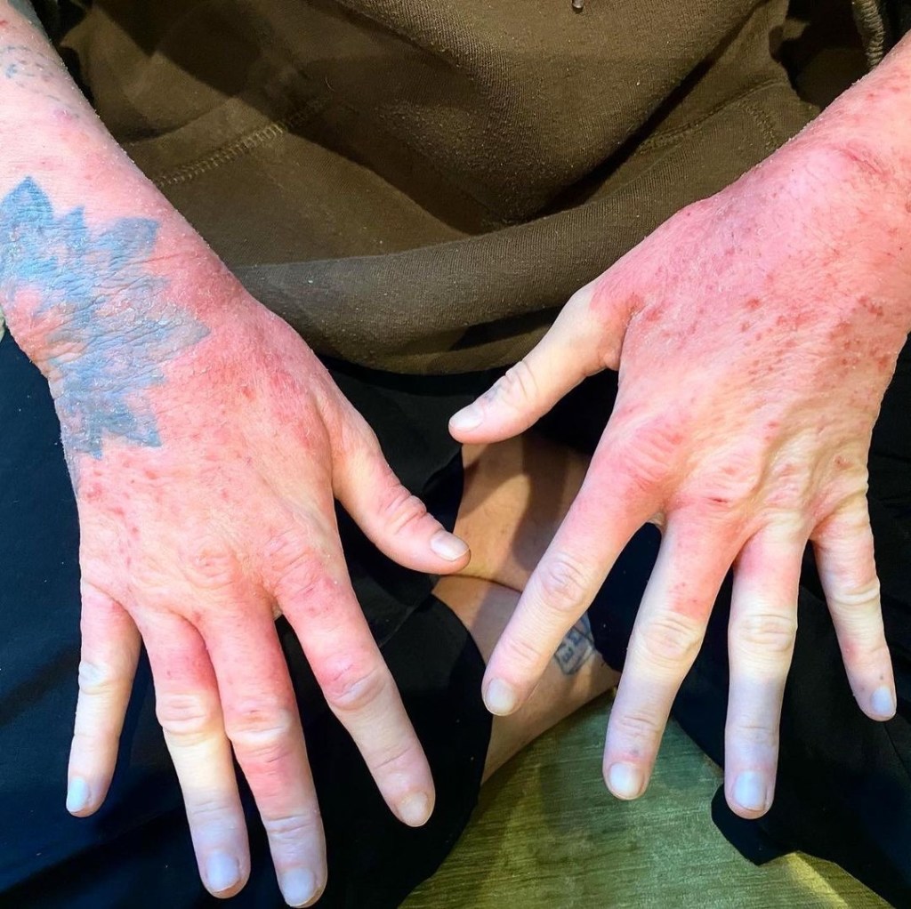 Topical Steroid Withdrawal and&nbsp;Stress