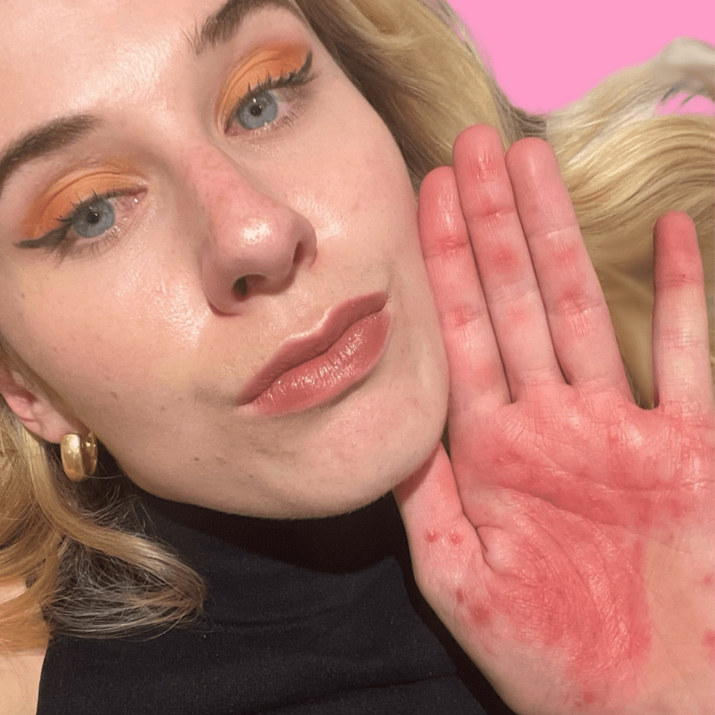 ECZEMA WARRIOR: Katie