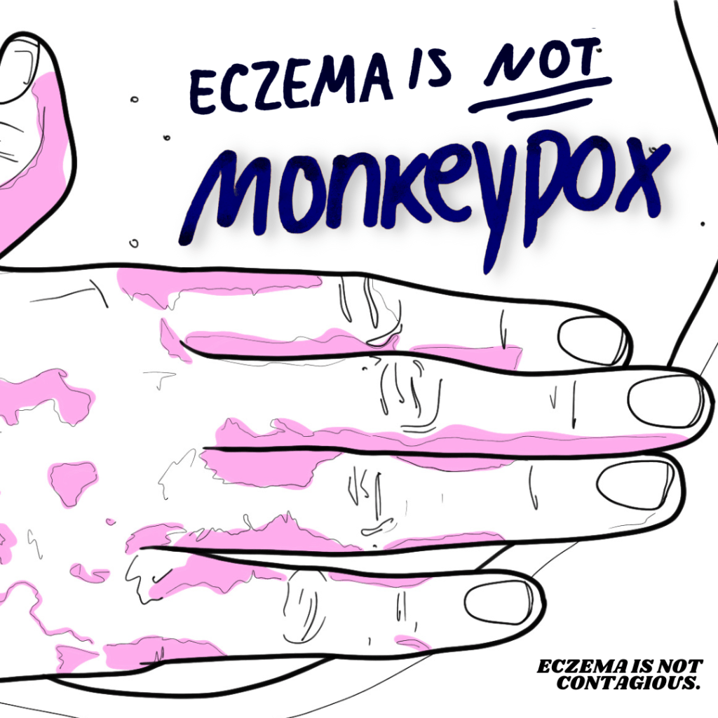 ECZEMA IS NOT&nbsp;MONKEYPOX