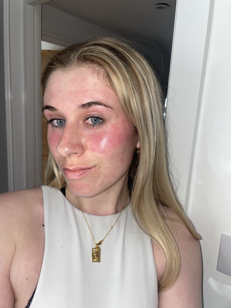 ECZEMA: I spent years perfecting how to hide my&nbsp;skin