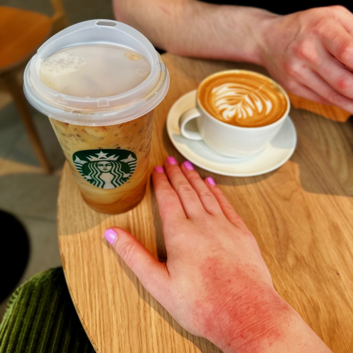 Flarey Mary, the Hand eczema&nbsp;🖐️