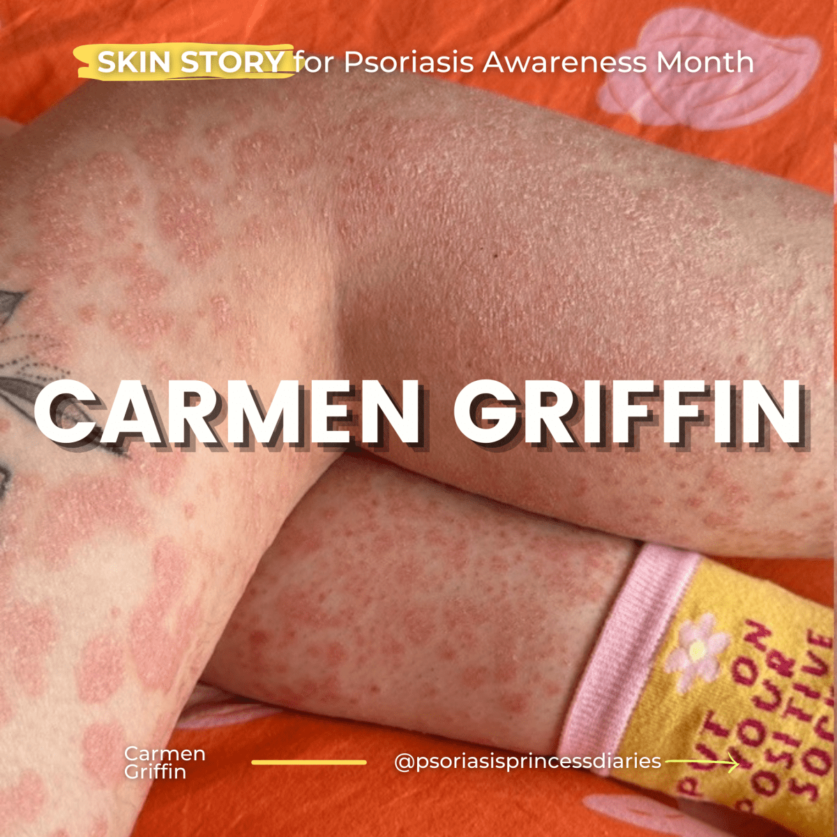 ✨Carmen Griffin✨AKA @psoriasisprincessdiaries shares her #SKINSTORY for #PsoriasisAwarenessMonth –&nbsp;#TheItchyGang