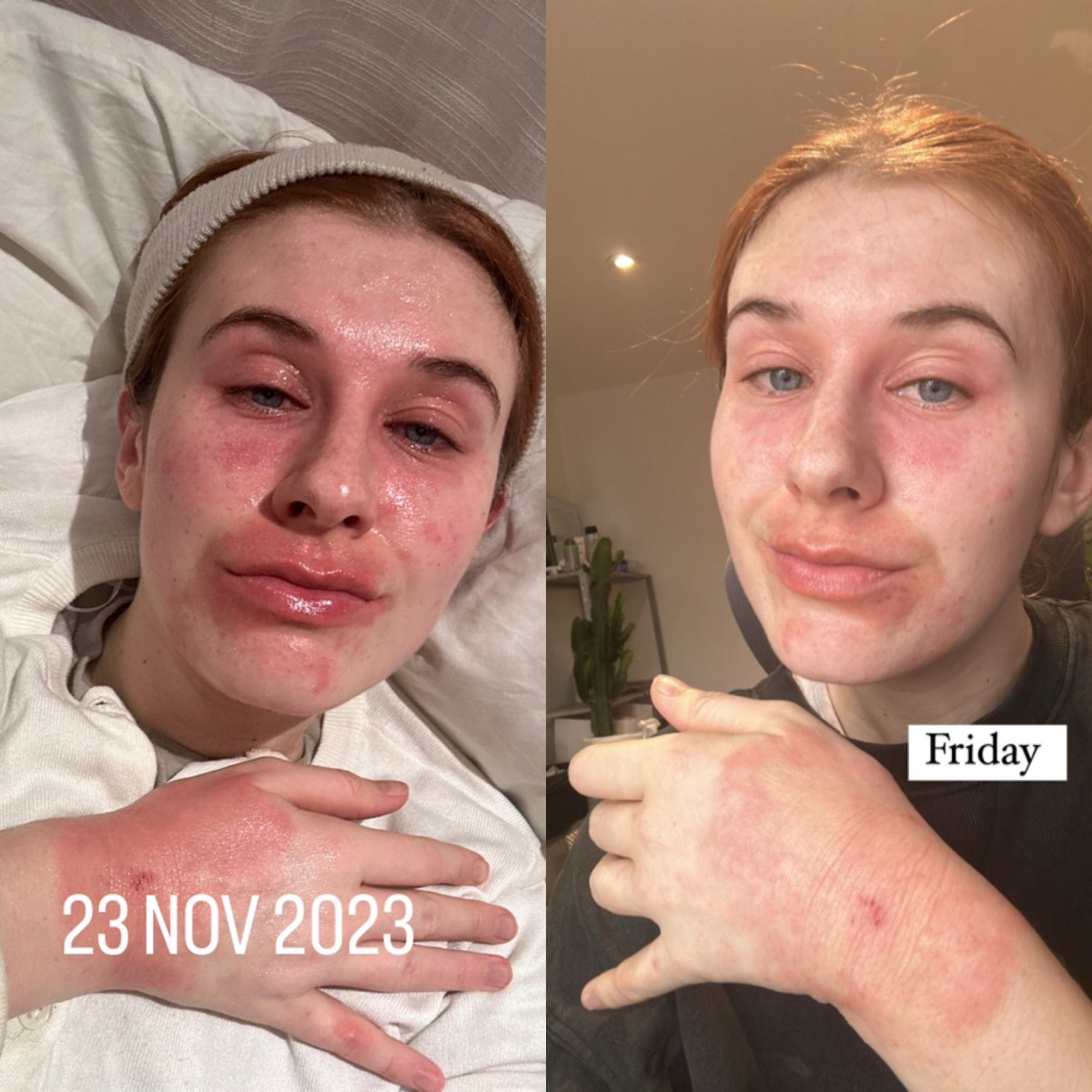 Everyday with eczema can look very different 👌🏻 