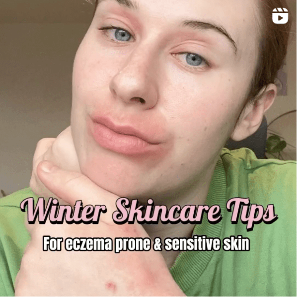 Winter Skincare Tips for Eczema-Prone and Sensitive&nbsp;Skin