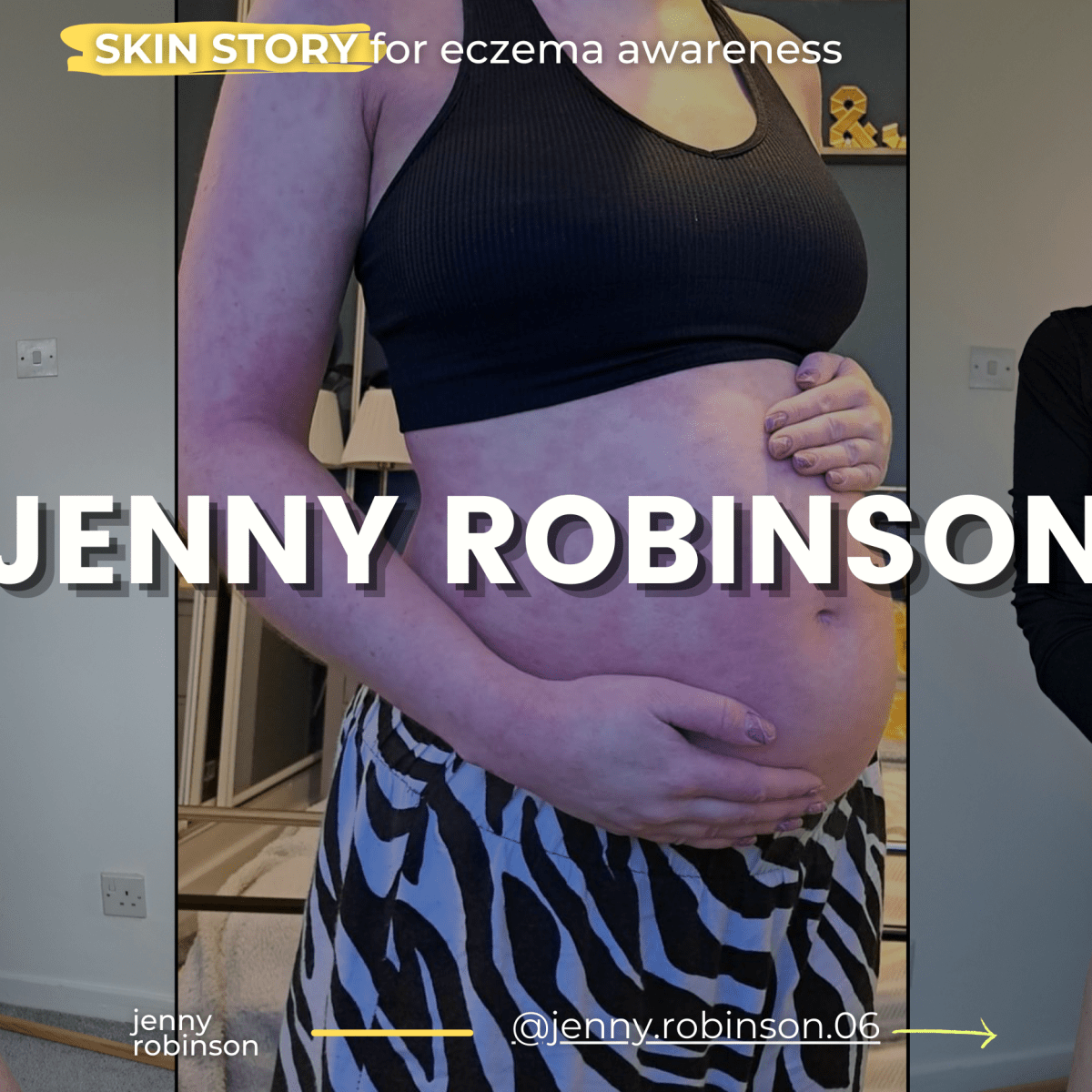 Jenny’s SKIN STORY – sharing for #EczemaAwareness