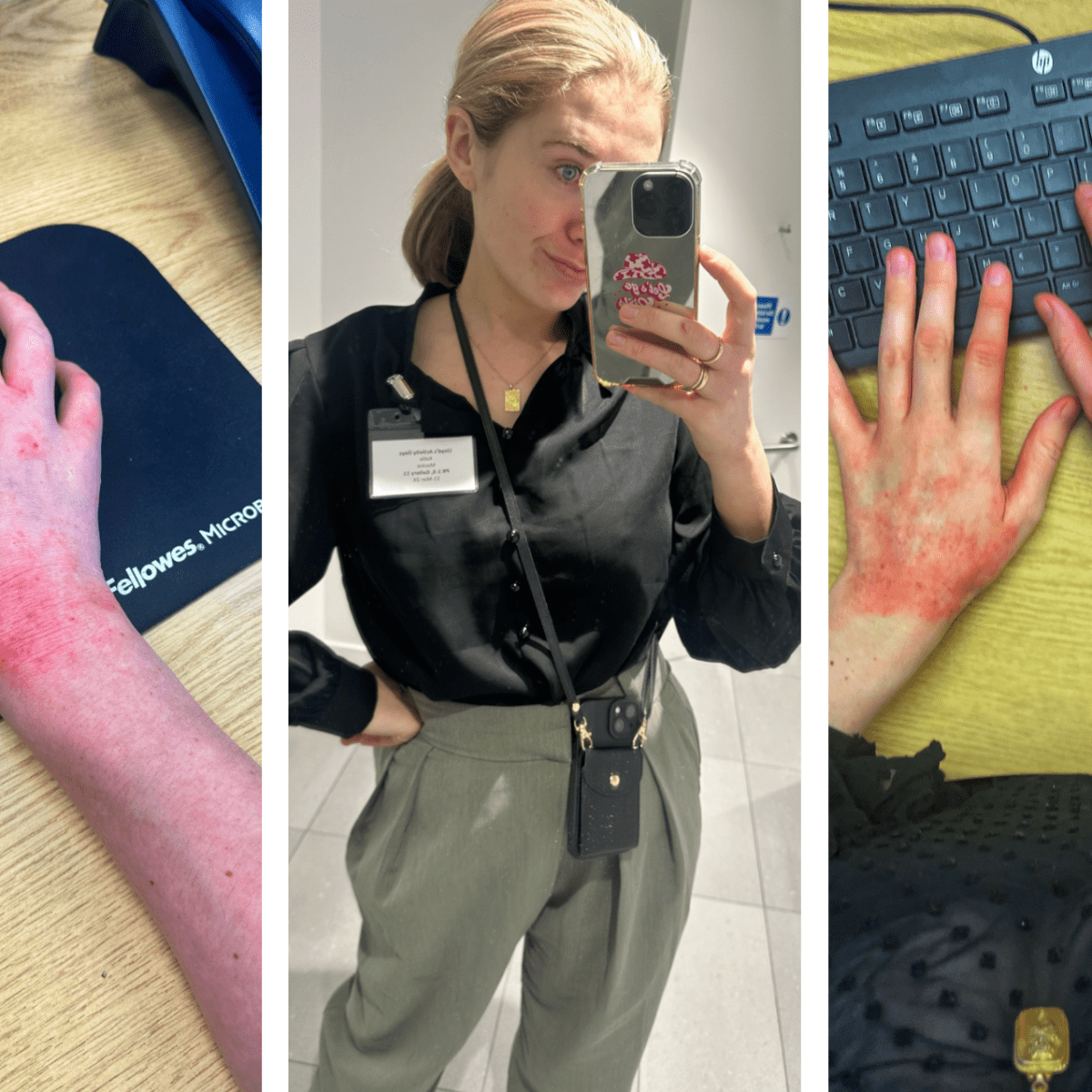 Itchin’ 9 to 5, makin’ a livin’🙋🏼‍♀️”How do you initiate conversations about ECZEMA with work and&nbsp;friends?”