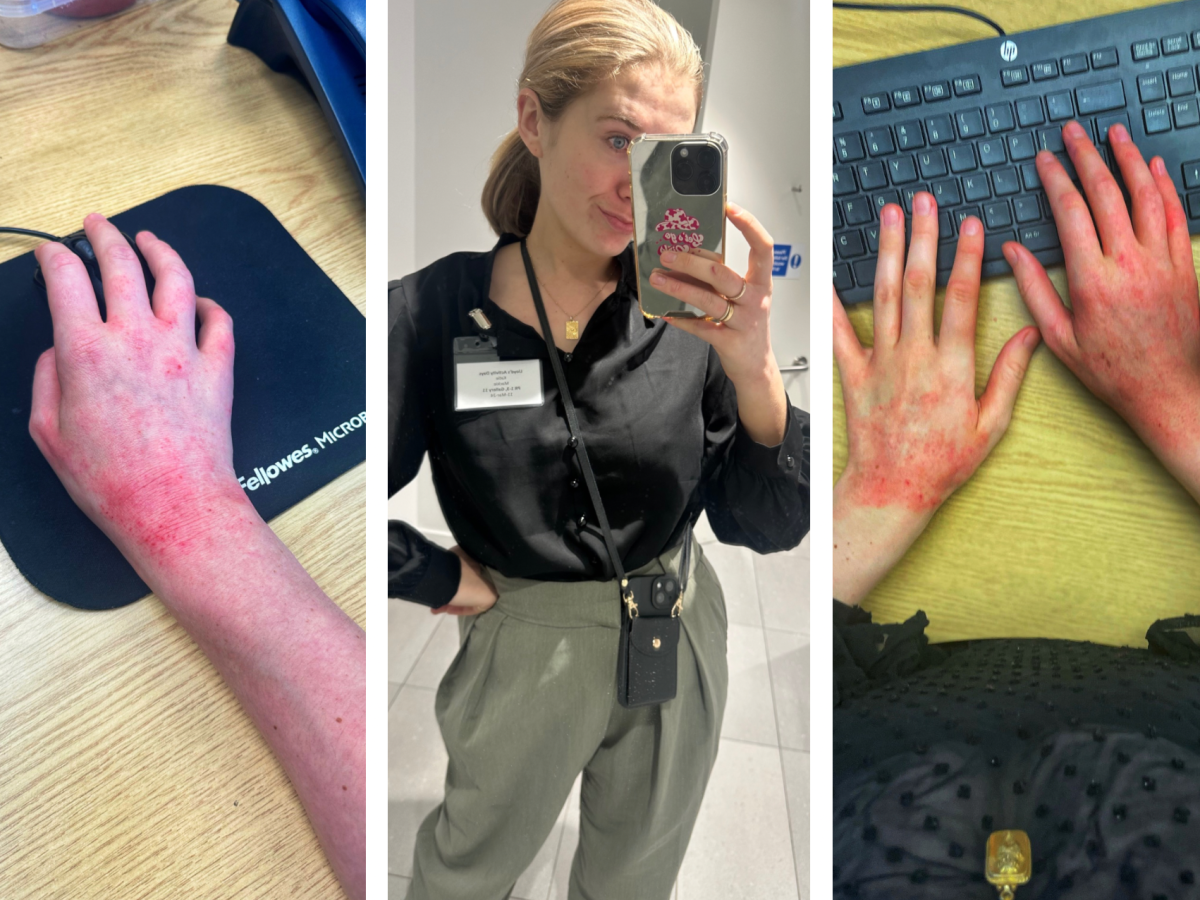 Itchin’ 9 to 5, makin’ a livin’🙋🏼‍♀️”How do you initiate conversations about ECZEMA with work and&nbsp;friends?”