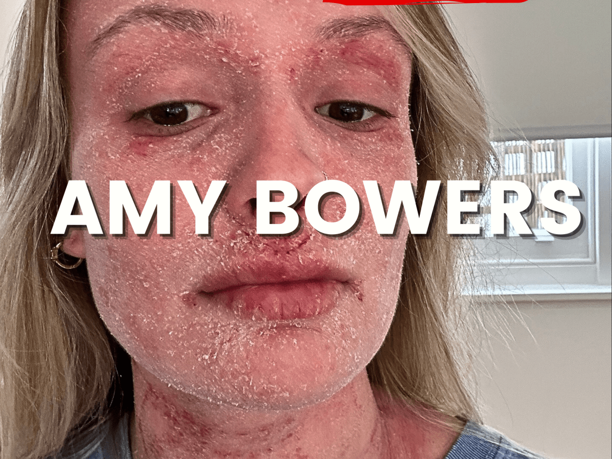 Amy Bowers✨ AKA @amy_does_tsw shares her SKIN&nbsp;STORY