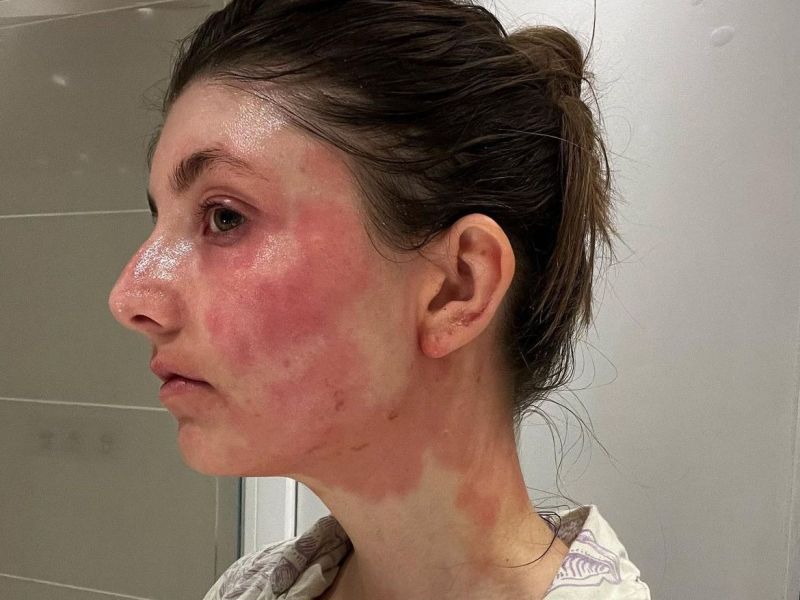 Saskia Potts✨ AKA @saskia.potts shares her SKIN&nbsp;STORY❤️‍🩹