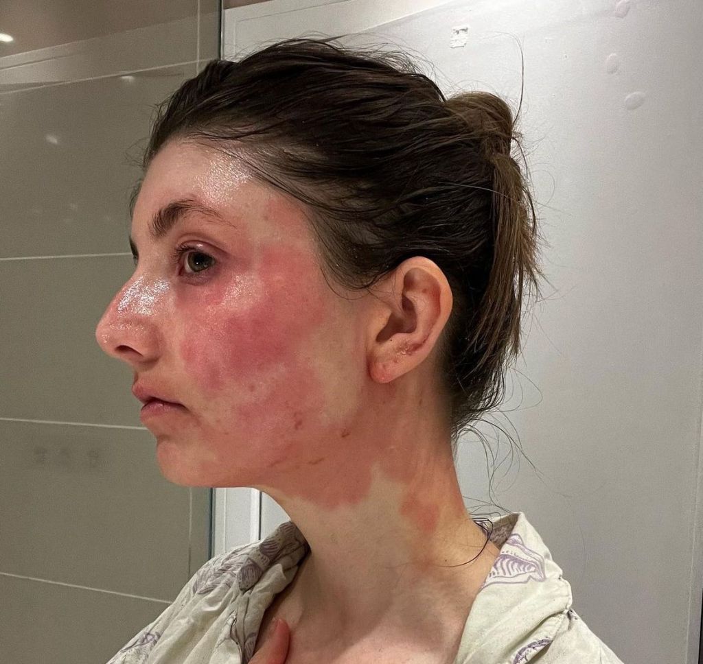 Saskia Potts✨ AKA @saskia.potts shares her SKIN&nbsp;STORY❤️‍🩹