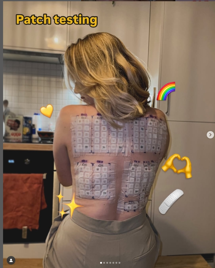 Patch testing – eczema / contact&nbsp;dermatitis